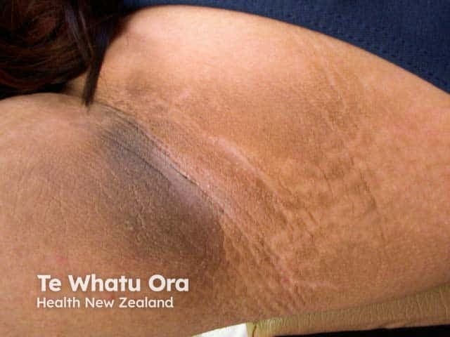 This dermatologic clinical photograph depicts classic axillary acanthosis nigricans: a velvety, hyperpigmented plaque within the skin folds of the axilla. The region shows diffuse brown-to-dark pigmented, lamellar texturing with parallel linear creases and fine wrinkling along skin folds. The texture appears velvety to the touch; there is mild skin thickening and uniform pigmentation without vesicles or erosions. The lesion is localized to the axillary area, typically associated with friction and perspiration, and commonly coexists with obesity, insulin resistance, or metabolic syndrome. On histology, epidermal hyperplasia with mild hyperkeratosis and papillomatosis would be expected, though not shown here. Clinically this finding signals possible systemic associations; in adults, screen for diabetes mellitus, impaired glucose tolerance, dyslipidemia, and obesity; in older patients or atypical presentations, consider paraneoplastic acanthosis nigricans associated with gastric or other malignancies. Differential diagnoses include frictional dermatitis, candidal intertrigo, and other pigmented dermatoses. The image supports educational usage in dermatology training, primary care screening, endocrinology workups, and radiology-dermatology correlation for cutaneous signs of systemic disease. The observation underscores the importance of comprehensive clinical assessment, lifestyle modification, and targeted laboratory evaluation to identify underlying etiologies and initiate appropriate management. Careful documentation of lesion characteristics improves reproducibility and supports longitudinal monitoring over time.