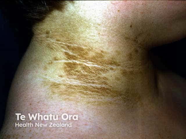 Clinical photography of the neck demonstrating acanthosis nigricans. This close-up dermatology image captures hyperpigmented, velvety plaques concentrated in the posterior and lateral cervical region. The epidermal thickening presents as dark-brown to slate-gray patches with diffuse, corrugated surface and subtle fissuring along skin folds. Palpation would reveal a soft, velvety texture consistent with hyperkeratosis. The condition commonly coalesces in intertriginous areas and may extend toward the base of the skull, with sparing of normal nonfolded skin. The appearance is often symmetrical and may be accompanied by mild irritation or friction. Underlying etiologies include insulin resistance, obesity, type 2 diabetes mellitus, and endocrinopathies; in older adults, malignant acanthosis nigricans can signal GI or other visceral malignancies. Differential diagnoses include frictional melanosis, post-inflammatory hyperpigmentation, and tinea versicolor. Clinically, this finding is a cutaneous marker prompting metabolic risk assessment and screening for metabolic syndrome, diabetes, and hormonal disorders. This image serves educational purposes for dermatology and internal medicine, illustrating classic morphology velvety, hyperpigmented plaques in the neck, along with the importance of clinical correlation and follow-up. Notably, treatment focuses on addressing the underlying cause and improving skin texture with topical keratolytics and barrier repair. Photograph notes: correlate with BMI, fasting glucose, insulin resistance, lipid profiles carefully.