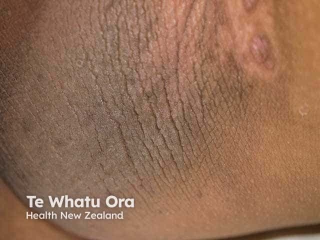 Clinical photograph of the axillary skin (upper inner arm) documenting acanthosis nigricans in the setting of obesity. This close-up dermatologic image demonstrates hyperpigmented, velvety plaques within flexural skin folds, with epidermal thickening and subtle papillomatosis along the basilar fold lines. The coloration ranges from dark brown to near-black, and the texture appears markedly roughened compared with adjacent noninvolved skin. The appearance is symmetric in typical obesity‑associated acanthosis nigricans, though unilateral presentation can occur. In context, the findings reflect insulin resistance driving keratinocyte proliferation and increased dermal matrix, producing the characteristic velvety hyperpigmented plaques of the axilla. Clinically, these signs signal metabolic syndrome risk and warrant screening for impaired glucose tolerance, type 2 diabetes, dyslipidemia, and obesity‑related comorbidities. The image is not a diagnostic modality by itself but serves as documentation for dermatologic assessment, obesity management, and endocrine correlation. Differential diagnoses include frictional dermatitis, postinflammatory hyperpigmentation, and rare malignant acanthosis nigricans in atypical presentations or older patients. This dataset label supports education, clinical correlation with BMI, and research on insulin‑resistance phenotypes; useful for medical trainees, dermatology and endocrinology teaching collections, and AI model training for skin disease recognition. Annotation aids clinical teaching, biopsy decision considerations, and automated annotation pipelines for medical imaging.