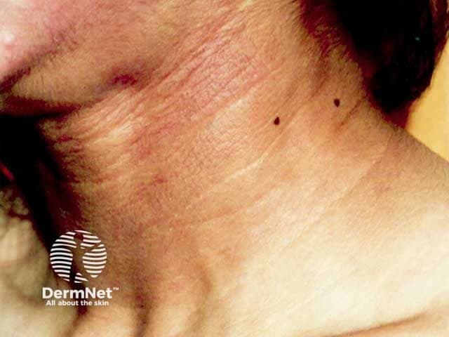Clinical photograph of the neck illustrating acanthosis nigricans in a patient with acquired generalized lipodystrophy. The image shows pigmented, velvety plaques organized in intertriginous folds along the lateral neck and posterior cervical skin. The hyperpigmented bands are dark brown to slate-gray, with slight gloss and mild accentuation of skin creases. The lesion demonstrates epidermal thickening with papillomatosis and prominent acanthosis of the stratum spinosum; there is no overt induration or ulceration. This cutaneous marker is classically symmetric and may extend to other flexural areas, consistent with insulin resistance–related acanthosis nigricans. In the clinical context of generalized lipodystrophy, reduced adipose tissue storage and severe insulin resistance predispose to such pigmentary changes. The appearance is distinct from post-inflammatory hyperpigmentation and from malignant acanthosis nigricans, which may accompany paraneoplastic processes. The differential diagnosis includes benign physiologic/acanthosis nigricans in obesity, drug-induced variants, and paraneoplastic variants; however, in this case, the association with lipodystrophy implies a metabolic/endocrine etiology. Recognition of this sign prompts metabolic workup including fasting glucose, insulin, lipid panel, and assessment for diabetes risk. Clinically, it guides management toward glycemic control, weight management, and monitoring for metabolic syndrome complications. This sign is a visible cue for multidisciplinary care, including endocrinology and nutrition support.