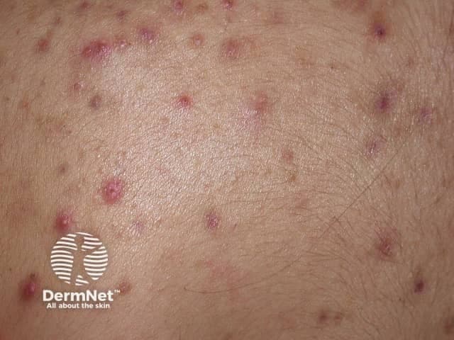 High‑resolution clinical photograph of the dorsal trunk demonstrating truncal acne lesions. This close‑up dermatologic image records the back skin in posterior view, with a focus on follicular papules and pustules at varying stages of inflammation. The observable features include small erythematous papules, superficial pustules with central necrosis, and subtle perifollicular redness against normal skin texture. No large nodules or cystic lesions are evident in the field of view. The distribution is scattered across the upper and mid back with a mixed inflammatory pattern, consistent with acne vulgaris affecting the trunk. The skin shows mild oiliness and tiny follicular openings; scale is minimal. The image emphasizes inflammatory sequelae rather than postinflammatory scarring. Clinically, these findings correlate with active sebaceous gland activity and Propionibacterium acnes–driven folliculitis. Differentials include folliculitis, keratosis pilaris, and less likely bacterial infection; clinical correlation and distribution help distinguish among etiologies. Diagnostically, this image supports a diagnosis of mild to moderate truncal acne and aids in patient education, assessment of treatment response, and dermatologic research on lesion morphology. Potential uses include educational demonstrations, photography‑based scoring, and outcome tracking in clinical trials of topical retinoids, benzoyl peroxide, and combination therapies.