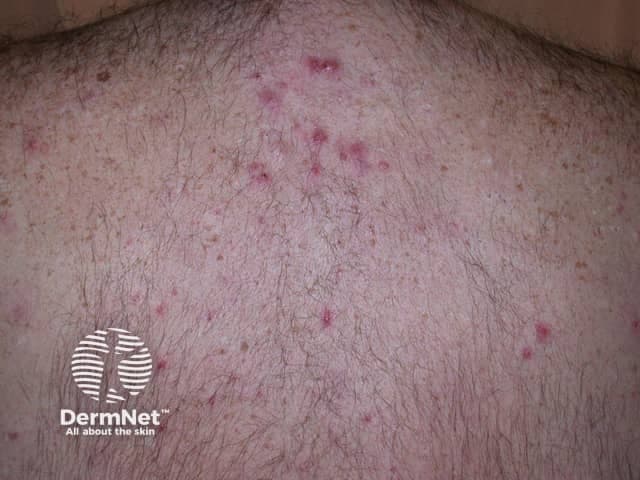 Clinical photography of the patient's upper back illustrating an inflammatory acneiform eruption consistent with folliculitis or acne related lesions. Modality: digital color photograph, posterior dorsal view of the thoracic back. The image shows multiple erythematous papules and a few pustules concentrated on the upper back and near the shoulders, with mild superficial crusting in a few lesions. Lesions are discrete, roughly 2-4 mm in diameter, with perifollicular erythema and a central palpably raised area. No large nodules or abscesses are seen on this field; the skin texture shows mild post-inflammatory hyperpigmentation in places. Hair follicles appear conspicuously involved, suggesting folliculitis or an acneiform eruption rather than a vesicular or scaly dermatosis. The distribution is truncal, predominantly in the upper back, with bilateral symmetry but no midline predilection. Clinically, this pattern favors bacterial folliculitis or acneiform dermatitis; fungal folliculitis (Pityrosporum) or pityrosporum-centric folliculitis could be considered in persistent cases, particularly with pruritus. Management implications include topical antiseptics, benzoyl peroxide, or topical/oral antibiotics depending on severity. Correlate with patient history: recent sweating, occlusive clothing, shaving, or trauma. This image is useful for education on trunk acneiform eruptions, differential diagnosis of folliculitis, and treatment planning.