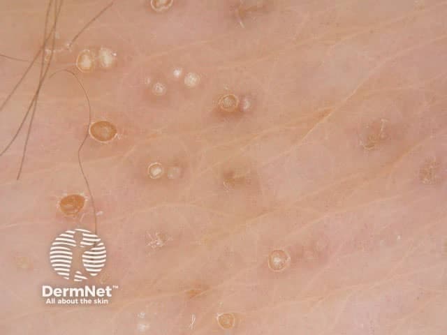 This dermatoscopic image captures a close-up view of multiple small, round papules within a sun-exposed cutaneous surface. The epidermal lesions display keratin-filled centers with pale to light-brown cores and surrounding translucent halos. Several openings resemble Milia-like cysts (small, bright-white to skin-colored droplets) and comedo-like openings (keratin plugs intrafollicular). The background skin is pink to beige with fine surface scaling and occasional fine hairs evident. The overall pattern is scattered, with heterogeneous sizes ranging from 0.5 to 3 mm. Pigmentary features are mild or absent, aligning with benign keratinous lesions rather than vascular or pigmented neoplasms. The morphology suggests seborrheic keratosis or sebaceous hyperplasia spectrum; however, absence of marked vascularization or crusting reduces suspicion for melanoma, basal cell carcinoma, or actinic keratosis in this field. Dermoscopic clues include keratin-filled structures (comedones/milia), sharply demarcated borders, and a lack of pigment networks. This image is valuable for educational demonstrations of common in vivo keratinous skin lesions and can aid in differential diagnosis among seborrheic keratosis, milium, and keratinous cysts. Potential clinical applications: lesion characterization in clinics, tele-dermatology triage, and dermoscopy training modules. Ideal for automated keyword indexing and comparative datasets; compatible with AI-based lesion classifier studies and medical education repositories.