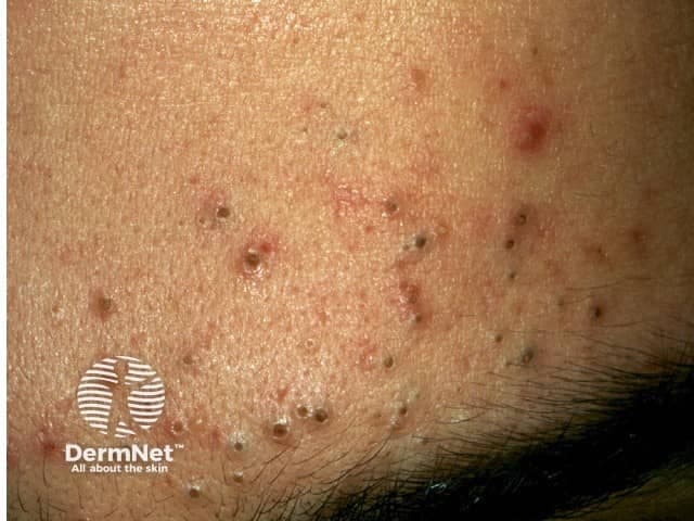 This is a high-resolution clinical photograph of the facial skin showing features characteristic of comedonal acne. Modality: Clinical photography (in vivo, dermoscopy not applied). The image presents a dense pattern of open comedones (blackheads) and occasional closed comedones (whiteheads) scattered across the cheek and perioral region, with minimal surrounding erythema and subtle post-inflammatory changes. The follicles are dilated with keratinous plugs protruding at the ostia, producing a reticulate texture and follicular papules. The skin surface is slightly oily, reflecting sebaceous activity. No pustules or nodules are evident, consistent with non-inflammatory acne predominance. The distribution is facial, bilateral or regionally on the lower malar area, typical for adolescent and early adult acne. The appearance may be influenced by measurement distance and lighting, but the core finding remains follicular plugging with keratin debris. This image is useful for educational illustration of comedone morphology, differential diagnosis (e.g., milia, keratosis pilaris), and guiding therapy decisions. Clinically, management would emphasize keratolytic and comedolytic strategies—topical retinoids, benzoyl peroxide, salicylic acid, and avoidance of comedone extraction to reduce inflammation risk. The photo provides a visual reference for patient counseling and dermatologic training in recognizing mild-to-moderate comedonal acne phenotypes. Useful for teaching, clinical case discussions, and reference libraries.
