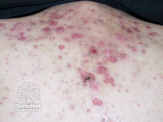 This is a clinical photograph of the back/trunk showing an extensive inflammatory acneiform eruption with scattered erythematous papules and pustules, some coalescing into superficial plaques. Lesions are follicular in distribution, centered around hair follicles, with perifollicular erythema and crusting. The skin appears slightly edematous with mild scaling. The pattern is diffuse across the upper and mid-back, with higher density in the central to lateral paraspinal regions. Several lesions show a central pustule or crust, suggesting secondary infection or rupture. No visible comedones are clearly evident in this view, but follicular involvement is evident. The appearance is compatible with folliculitis or acne vulgaris involving the trunk; differential includes pityrosporum folliculitis or a contact dermatitis-driven papulopustular eruption. There is no edema of deeper tissues; no ulceration or necrosis except one crusted lesion with small crater. The image is taken under standard clinical lighting with a neutral background; no contrast or magnification. Clinically relevant significance: trunk acneiform eruptions can be painful, pruritic, and cosmetically distressing; management typically includes topical retinoids, benzoyl peroxide, antibiotics (topical or oral for moderate to severe disease), and addressing inflammatory components. This image is useful for educational discussion of differential diagnosis, truncal skin infections, and dermatologic therapy planning and education.