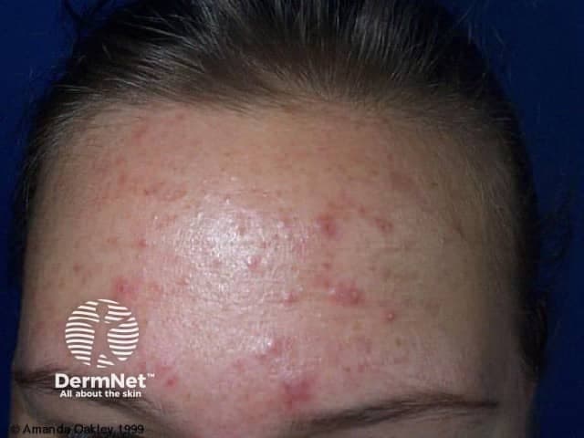 Clinical photography of the frontal face demonstrating mild to moderate inflammatory acne on the forehead during pregnancy. Imaging modality: Clinical photograph (dermatology), frontal/anterior view. The frontal region shows grouped erythematous papules with variable surface irregularity and a few discrete pustules, primarily in the central and upper forehead within the T-zone pattern. Comedones are partially visible as tiny non-inflammatory plugs. There is no overt nodular lesion or scarring in this image. The skin appears mildly oily with slight shine, consistent with hyperseborrhea commonly associated with pregnancy. The presentation is consistent with acne vulgaris in a hormonally driven context, i.e., gestational acne, characterized by increased sebum production from elevated androgens and pregnancy-related hormonal fluctuations. Differential considerations include rosacea, folliculitis, and irritant/contact dermatitis, but the predominant morphology and distribution favors inflammatory acne. Clinically, this image is relevant for dermatology and obstetric practice because it informs safe management during pregnancy: emphasize non-teratogenic therapies, gentle cleansing, noncomedogenic moisturizers, benzoyl peroxide use, possibly topical erythromycin or clindamycin, and avoidance of systemic retinoids (isotretinoin) and tetracyclines. The image supports educational discussion on pregnancy-safe dermatologic care, hormonal acne pathophysiology, and treatment tailoring for maternal-fetal safety. Clinician note: monitor acne progression; re-evaluate therapy if pregnancy course changes or complications.