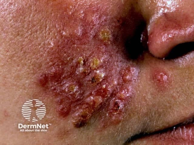 Clinical photography of the mid-face demonstrates a severe inflammatory rosacean eruption consistent with pyoderma faciale (rosacea fulminans). The image shows an asymmetric, left-sided distribution involving the malar cheek and perioral skin with confluent erythema, edematous plaques, and numerous yellow-brown crusts overlying fragile erosions. Superficial pustules and papules coalesce into broad plaques, with surrounding telangiectatic vasculature and subtle induration. The skin appears tender to palpation in the affected zones; the nose, nasolabial folds, and surrounding cheek show intense inflammation, while adjacent non-lesional skin remains relatively unf acted. There is no obvious sign of systemic infection; the presentation is acute in onset with abrupt inflammatory burden, suggesting rosacea spectrum rather than acne vulgaris or impetiginized dermatitis. The imaging modality, a high-resolution clinical photograph, provides rapid documentation of morphology, distribution, and severity, assisting differential diagnosis, treatment planning, and longitudinal monitoring. Clinically, this entity requires prompt, targeted therapy to reduce inflammation, prevent scarring, and manage potential triggers; management commonly involves systemic antibiotics (e.g., doxycycline) and anti-inflammatory regimens, with cautious corticosteroid use in select cases. Recognizing pyoderma faciale within the rosacea family is essential to differentiate from acne fulminans and infectious etiologies, guiding dermatologic evaluation and patient counseling. Accurate labeling supports diagnostics, research, and education globally.