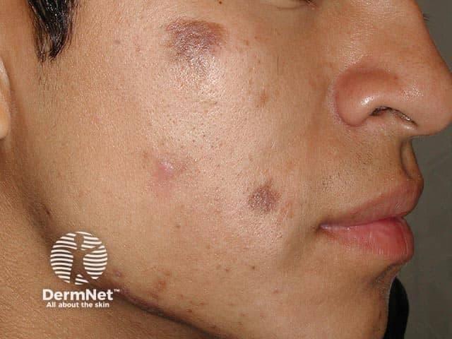 Dermnetnz
