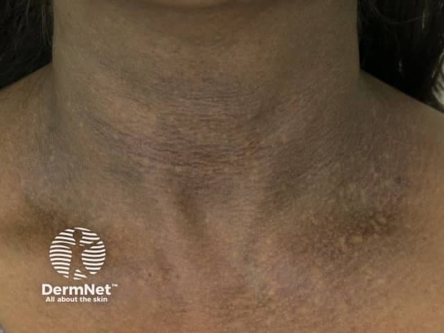 Clinical photography of the anterior neck reveals diffuse, symmetric hyperpigmentation with a thick, velvety, papillomatous texture classic for acanthosis nigricans. The plaques concentrate in neck flexures and along anterior cervical folds, extending laterally toward the upper chest. Color ranges from dark brown to slate-gray, with subtle variation between individual fold lines. The surface appears slightly creased and lichenified, but without overt ulceration, crusting, or scale. No acute erythema or edema is evident. In some regions, the pigmentation blends with adjacent normal-appearing skin, suggesting early or mild involvement. The pattern is typically bilateral and intertriginous, reflecting increased epidermal thickness and papillomatosis with dermal melanosis. Clinically, acanthosis nigricans is a cutaneous marker of insulin resistance, obesity, type 2 diabetes mellitus, endocrine disorders, or, less commonly, paraneoplastic processes. This image supports a differential that includes postinflammatory hyperpigmentation and frictional dermatitis in flexural areas, but the uniform texture and location strongly favor AN. The clinical significance lies in prompt metabolic screening and associated risk factor modification; management includes addressing underlying metabolic conditions, weight reduction, and consideration of dermatologic therapies for texture and pigment reduction. Educational utility includes teaching recognition of flexible-neck involvement and differentiation from other dermatoses in dermatology training and research.