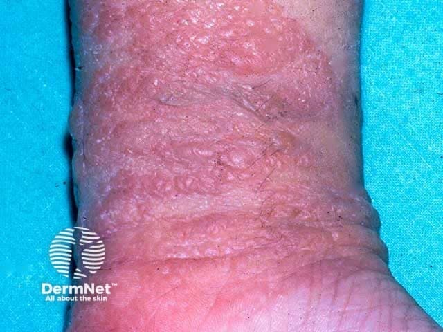 Clinical photography of the dorsal left wrist demonstrates an acute, moist dermatitis confined to the adhesive contact zone of a sticking plaster. High-resolution color image shows erythematous, inflamed skin with pronounced edema, surface crinkling, and serous oozing. Superficial vesiculation is present at the margins of the lesion, with excoriations and crust formation indicating ongoing excoriation from pruritus and rubbing. The distribution is linear to irregular along the plaster edge, reflecting contact with the adhesive and backing material. The surrounding skin is mildly inflamed but without deep ulceration or panniculitis. The appearance is compatible with allergic contact dermatitis, a type IV hypersensitivity reaction to components of plaster adhesives such as acrylates or natural resins (colophony) in susceptible individuals. Differential diagnoses include irritant contact dermatitis from adhesive exposure, irritant dermatitis, or to a lesser extent eczema/atopic dermatitis restricted to the site. Clinical significance lies in identifying a contact allergen and guiding avoidance; patch testing to confirm sensitization to plaster constituents is recommended. Management implications include allergen avoidance, topical corticosteroids to reduce inflammation, and emollients to restore barrier function. This image is relevant for dermatology education, allergology, patch-testing literature, and clinical practice guidelines on contact dermatitis and plaster allergies. Useful for clinical education.