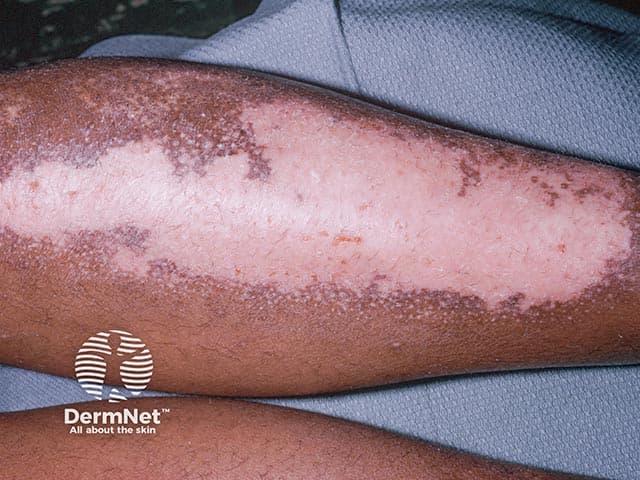Clinical photograph of forearm skin showing vitiligo camouflage patches with concurrent allergic contact dermatitis to cosmetic camouflage pigments. Imaging modality: Clinical photography; technique: Standardized dermatologic photography. Forearm skin demonstrates large, well-demarcated hypopigmented macules consistent with vitiligo camouflage; pattern borders the depigmented zones, creating a patchy mosaic with variable pigmentation and a paler central area. Surrounding erythema, scaling, and crusting indicate an inflammatory response consistent with allergic contact dermatitis to camouflage constituents. The dermatitis is most pronounced at the periphery of the camouflage application, indicating sensitization to a cosmetic dye, binder resin, fragrance, or preservative component. Textural change and surface desquamation contribute to skin irritation and potential secondary infection risk if scratching occurs. Anatomical localization is cutaneous, in the superficial to mid-dermis, on the volar aspect of the forearm. Clinically, this finding raises suspicion for a cosmetic-related ACD in vitiligo patients and highlights the need for allergen identification via patch testing. Management implications include avoidance of suspected agents, topical corticosteroids or calcineurin inhibitors for inflammation, barrier repair emollients, and potential referral to dermatology for patch and photo-patch testing. Documenting this image supports differential diagnoses, clinical correlation, and patient education on cosmetic safety and vitiligo camouflage.