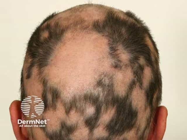 Clinical photography of the scalp in a patient with extensive patchy alopecia areata. Modality: Dermatologic/clinical photography, high-resolution digital image, frontal-vertex perspective capturing the alopecic patches within the parietal and occipital regions. The scalp shows numerous well-circumscribed, irregularly shaped patches revealing exposed skin with minimal perifollicular erythema. Hair density is markedly diminished in affected zones with patchy distribution across the vertex, temples, and crown, consistent with non-scarring alopecia. The surrounding hair demonstrates variable thinning and preserved follicular openings at lesion margins. The appearance is typical for autoimmune-mediated hair loss where hair follicles are not destroyed but temporarily arrested; no scarring or dyspigmentation is evident. The differential diagnoses include alopecia areata, tinea capitis, telogen effluvium, and traction alopecia, though the presence of discrete patches and preserved skin architecture supports alopecia areata. Therapeutic implications include consideration of corticosteroid therapy, topical immunotherapy, or JAK inhibitors based on extent and progression. Clinically relevant associations may involve other autoimmune conditions such as thyroid disease, vitiligo, or diabetes. For education and research, this image demonstrates the classic pattern of patchy, non-scarring alopecia affecting the vertex and periauricular regions, highlighting diagnostic criteria, disease monitoring, and response assessment to therapy.