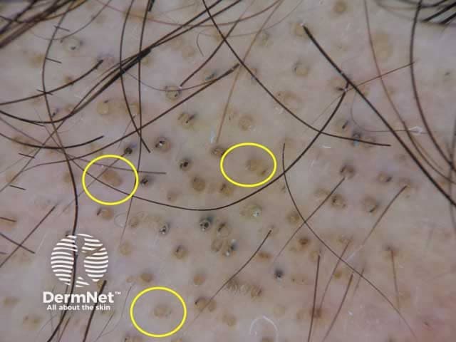 Low-power dermoscopic evaluation of the scalp in alopecia areata reveals diagnostic yellow dots and dark perifollicular dots. In this in vivo dermoscopy image, numerous yellow dots indicate keratin-filled follicular infundibulae, where the hair shafts are absent or completely regressed. Superimposed black dots reflect pigmented, broken hair shafts lodged at follicular openings. The surrounding skin shows relatively preserved texture without extensive scarring or scale, consistent with non-scarring alopecia. Follicular ostia are occasionally dilated and plug-filled by keratinous material, while visible hair shafts within these follicles are lacking, producing the signature AA pattern. The lesions appear as discrete, patchy alopecic areas on the scalp; the appearance is typical for early to mid-stage alopecia areata, though exclamation mark hairs may be absent in some images. Dermoscopy is performed in vivo, using polarized and non-polarized light modes, at approximately 10–20x magnification, enabling visualization of follicular openings and dot patterns. Clinically, these features correlate with autoimmune-mediated hair cycle disruption and a favorable response to intralesional or topical therapies. This image is diagnostic when correlated with history of sudden patchy hair loss and supports monitoring treatment response and disease activity in AA patients. These findings strengthen diagnostic confidence and guide therapeutic strategy for individualized AA management.