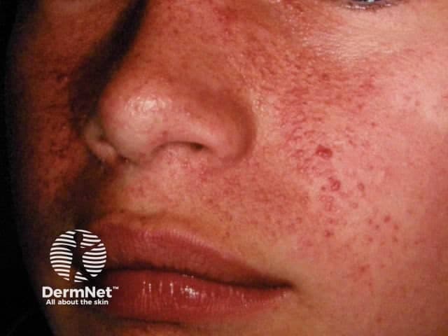 This is a high‑resolution clinical photograph of facial skin showing angiofibromas in a patient with tuberous sclerosis complex (TSC). Modality: Clinical photography, dermatologic photography; view: frontal, close‑up of the midface including the nasal bridge, cheeks, and perioral region. Anatomical localization: cutaneous integument of the face, malar and perinasal skin. Visual features: numerous small, dome‑shaped, erythematous papules (~1–3 mm) arranged in symmetrical clusters along the malar and nasolabial areas, with mild background erythema and occasional coalescence. The lesions are nonulcerative and level with the surrounding skin; vessels may appear prominent in aggregates. When biopsied histologically, angiofibromas demonstrate fibrous stroma with dilated capillaries; clinically they present as reddish papules and plaques without pigment loss. Clinical significance: a hallmark cutaneous manifestation of TSC and a major diagnostic criterion; supports diagnosis in conjunction with other TS features (hypomelanotic macules, cortical tubers, subependymal nodules, shagreen patch). Potential clinical use cases: diagnostic confirmation, monitoring of treatment response to laser or topical mTOR inhibitors, and educational reference for dermatology, pediatrics, and medical education. Differential considerations: acne vulgaris, rosacea, folliculitis, sebaceous hyperplasia. Image context notes: Ensure color fidelity for vascular intensity; include clinical history of TS; document trajectory of lesions over time to support phenotypic progression and therapeutic planning.