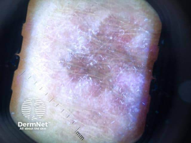 This in vivo dermoscopic image (Dermoscopy) captures a recent-onset annular lichen planus lesion on the forearm. Examined with polarized dermoscopy at standard magnification, the lesion shows an annular plaque with a pale, slightly erythematous center and a thin, scaly periphery. Under dermoscopy, characteristic Wickham striae manifest as interlacing white lines across the surface, most evident around the inner border, aligned with the lesion’s contours. The pale center displays subtle translucency with mild pigment network disruption. There may be faint perifollicular hyperpigmentation and minimal vascularity. The border remains well defined, with a subtle reddish halo suggesting active dermatitis. Combined findings—white reticulation, peripheral scaling, and central clearing—are typical for LP and help distinguish from tinea and psoriasis. The image provides clues for clinical diagnosis, such as recent onset, annular morphology, and lack of pustular features. Clinically, LP often presents pruritic, violaceous, polygonal papules; annular variants may exhibit central clearing and active borders. Dermoscopy enhances diagnostic confidence by highlighting Wickham striae and interface changes; these features correlate with histopathology showing interface lichenoid inflammation, sawtooth rete ridges, Civatte bodies, and basal vacuolization. Relevant clinical scenarios include evaluating suspicious annular lesions on extremities, differentiating LP from pityriasis rosea, psoriasis, or fungal infections; guiding biopsy decisions and treatment planning.