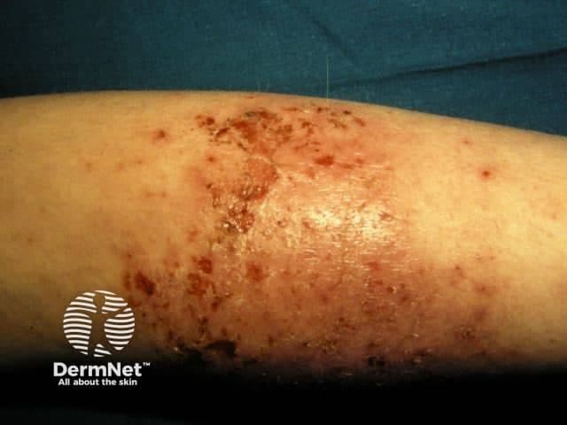 Dermnetnz