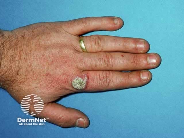 Imaging modality: Clinical photography of a cutaneous lesion on the dorsum of the left hand. This external photograph shows a solitary verrucous plaque with a crusted, scale-covered surface located over the dorsal metacarpal region. The lesion is erythematous to violaceous with mild surrounding edema and subtle desquamation. The surface demonstrates hyperkeratosis with a pale crust and a slightly indurated base; surrounding skin appears non-bullous and without deep ulceration. The overall morphology is characteristic of a chronic granulomatous, tuberculoid-type lesion presenting as a warty, exophytic nodule that may ulcerate or drain. In the clinical context of warty Mycobacterium marinum infection (fish-tank granuloma), aquatic exposure or minor hand trauma in a water-related environment is a critical clinical clue. Lesions typically affect extremities and evolve over weeks to months. Differential diagnoses include cutaneous tuberculosis, other non-tuberculous mycobacterial infections (e.g., M. kansasii), sporotrichosis, nocardiosis, mycetoma, verruca vulgaris, and pyogenic granuloma. Definitive diagnosis requires biopsy with histopathology showing granulomatous inflammation and possible Langhans giant cells, culture on Lowenstein-Jensen/Middlebrook media, and molecular assays (PCR). Therapeutic significance lies in selecting combination antimicrobials (e.g., rifampin with ethambutol or clarithromycin) for prolonged courses. This image supports dermatology education, infectious disease training, and case-based teaching on atypical mycobacterial infections. Education.