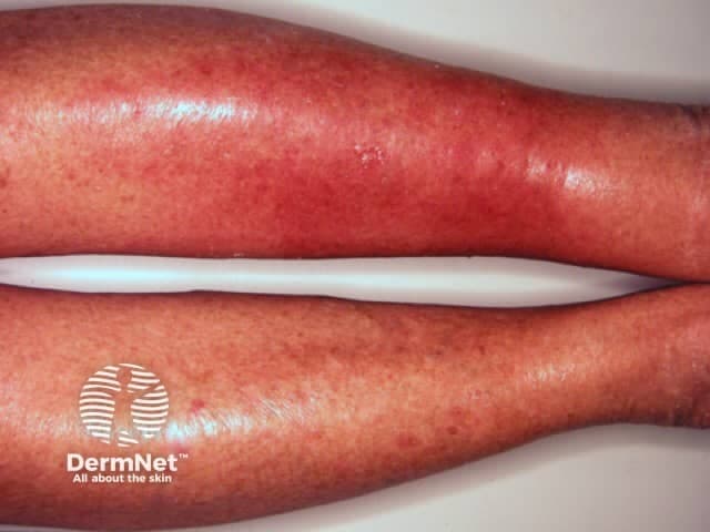 This is a clinical photograph of the left lower leg demonstrating features compatible with acute bacterial cellulitis, most likely streptococcal in origin. Imaging modality: clinical photography of the skin and soft tissues; technique: standard dermatology photography of the extremity with even, diffuse illumination to assess color, warmth, and edema. Anatomical location: left leg, lower leg region involving the skin and subcutaneous tissue; body region: integumentary system of the left limb. Visual features: diffuse, confluent erythema with pronounced warmth and edema; tender, swollen, and hot to palpation as described; margins are ill-defined; skin surface appears taut and glossy, with possible mild vesiculation or surface desquamation not clearly seen; no obvious abscess or necrosis identified; no obvious lymphangitic streaking in the visible field. Pathology/etiology: non-purulent, spreading infection of cutaneous and subcutaneous tissues due to Streptococcus species; neutrophilic inflammation with edema and vascular congestion may be inferred; potential risk of cellulitis-related complications if untreated (lymphangitis, bacteremia). Diagnostic significance and clinical correlation: supports clinical diagnosis of acute cellulitis in the appropriate context (fever, leukocytosis, localized warmth, swelling); useful for documentation, education, and telemedicine triage. Differential considerations: stasis dermatitis, dermatitis, deep vein thrombosis, erysipelas, necrotizing fasciitis (less likely). Clinical use cases: dermatology education, infectious disease review, antibiotic selection guidance, follow-up assessment, patient counseling.