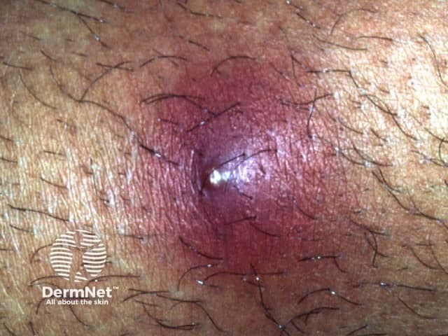 Clinical photograph of a single inflamed dermal lesion consistent with a boil (furuncle) on hairy skin. Modality: clinical photography with macro close-up; high magnification reveals a dome-shaped, erythematous nodule centered on a pus-filled core. The lesion demonstrates a shiny surface, surrounding perilesional edema, and visible follicular structures nearby. The central pale-yellow-to-white pustule indicates active purulent discharge; the erythematous halo suggests acute bacterial infection commonly due to Staphylococcus aureus. There may be crusting at the lesion rim if drainage has begun. The image captures surface features without depth assessment; no clearly delineated surrounding abscess cavity is evident, though edema indicates inflamed dermis and perifollicular inflammation. Clinically this lesion is typically painful, tender, and warm to touch, with potential progression to cellulitis if untreated. Management includes warm compresses, analgesia, and consideration of antibiotic therapy or incision and drainage for larger or fluctuant boils; culture may be performed in recurrent or non-resolving cases. This image is educational for dermatology training, infectious disease differential, and clinical photography repositories, aiding recognition of the pustule-with-edema configuration and localized follicular infection.