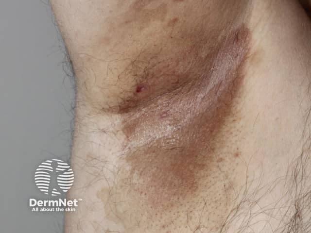 Clinical photography of the left lateral neck demonstrating a localized hyperpigmented plaque. Imaging modality: visible-light clinical photograph; technique: standard non-dermoscopic frontal view with diffuse lighting; no contrast. The lesion resides in the integumentary system, specifically the cervical skin, within the left neck region, at the intersection of anterior and lateral neck. The appearance is a broad, irregularly outlined, brown-to-dark brown patch measuring several centimeters in greatest dimension. Surface texture ranges from smooth to subtly velvety; mild hyperkeratosis and slight gloss may be present. The borders are variably defined, with some areas showing slightly blurred margins against surrounding lighter skin. There may be minimal overlying scale or tiny papules in the perilesional skin. Differential considerations include acanthosis nigricans (friction-induced or endocrine-associated) presenting as velvety, hyperpigmented plaques; post-inflammatory hyperpigmentation; frictional melanosis; pityriasis versicolor variants; and less likely pigmented seborrheic keratosis or dysplastic nevus. Clinically, this finding warrants assessment for metabolic or endocrine associations if acanthosis nigricans is suspected, including obesity, insulin resistance, diabetes, and any syndromic disorders. A biopsy or dermoscopic evaluation may be considered if diagnosis remains uncertain or malignant transformation is a concern; correlate with systemic symptoms. Documentation for indexing includes: hyperpigmented neck plaque, velvety neck lesion, dermatologic finding feature.