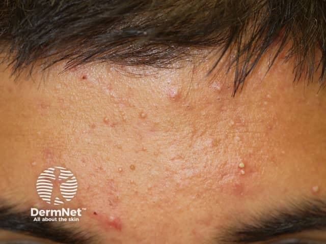Clinical photography of the anterior forehead demonstrates an acneiform eruption with predominately follicular lesions. Imaging modality is digital clinical photography with a frontal, close-up view capturing the central facial T-zone. The skin surface shows multiple small erythematous papules and a mixture of open and closed comedones (blackheads and whiteheads), with mild superficial desquamation and subtle perifollicular erythema. The sebaceous-rich forehead displays uniform texture with hypertrophic pores and minimal scales, consistent with mild-to-moderate acne vulgaris. No scars or atrophic changes are evident in this field; overall complexion remains oily. The distribution is localized to the forehead, with extension toward the eyebrows and glabella in a typical seborrheic pattern; however, the lesions are most dense in the central forehead region. Visual features include pearly-to-red papules, comedonal plugs within pilosebaceous units, and occasional pinpoint pustules that suggest early inflammatory activity. Clinically, these findings correlate with increased sebum production, follicular hyperkeratinization, Propionibacterium acnes involvement, and inflammatory mediators. Diagnostic significance lies in recognizing common acne vulgaris to guide topical keratolytic and anti-inflammatory therapy, monitor response to treatment, and differentiate from rosacea, folliculitis, or keratosis pilaris. This image is suitable for educational demonstrations, dermatology training, primary care documentation, and therapeutic planning. Clinician education and patient counseling.