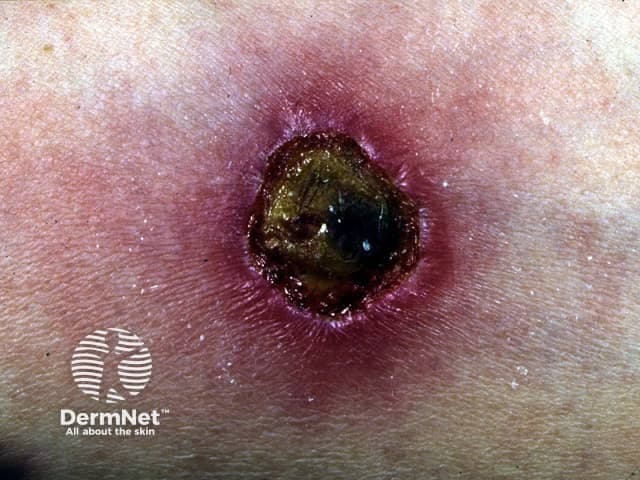 Clinical photography of a Mantoux tuberculin skin test reaction performed on the forearm. Imaging modality: clinical photography; technique: high-resolution, close-up digital photograph under standard lighting; magnification: macro. Anatomical location: forearm skin at the intradermal injection site of tuberculin purified protein derivative (PPD). Visual features: a circular, ulcerated patch with a dark necrotic center, surrounded by a violaceous to pink erythematous halo, peripheral induration, and surrounding edema. Crusting is evident at the lesion margin, with a slightly sunken center. Pathophysiology: this appearance suggests a pronounced delayed-type hypersensitivity reaction (Type IV) to tuberculin; in some cases, intense reactions may produce ulceration or necrosis, though mild induration is more common. Differential diagnosis includes an overly vigorous Mantoux reaction, superimposed infection (impetigo or cellulitis), or injection-site ulceration, and should be correlated with induration size measured after 48–72 hours and clinical history. Clinical significance: a positive reaction indicates TB exposure or BCG vaccination response, but interpretation depends on risk factors and time since exposure. Potential clinical use: TB screening, exposure assessment, vaccine response evaluation, dermatology teaching, medical education, and research training in cutaneous hypersensitivity. Note: lesions of this severity are uncommon in routine screening and require urgent clinical correlation. Documentation should include induration measurement and patient risk factors.