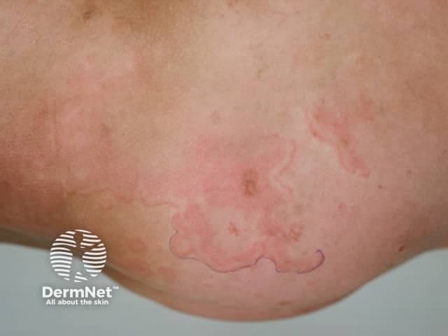 Clinical photograph (dermatology) showing erythema marginatum, an annular, non-itchy rash characteristic of acute rheumatic fever. The image depicts multiple pink to red circular to oval patches on the skin of the lower extremity with sharply demarcated, serpiginous margins and centers that appear pale or clearing. Lesions are non-vesicular, smooth-surfaced, and vary in size, with a tendency to migrate or transiently flare. The distribution favors the trunk and proximal limbs and typically spares the face. On close inspection the patches lack scaling and crusting, consistent with erythema marginatum rather than dermatitis or fungal infection. This cutaneous manifestation is part of the Jones criteria and may correlate with concurrent migratory polyarthritis, fever, and evidence of preceding group A Streptococcus infection. Histologic features (if biopsied) would show superficial perivascular lymphocytic infiltrate and dermal edema with minimal epidermal changes; clinically, the rash is a marker for systemic inflammatory involvement. Differential considerations include urticaria, erythema multiforme, tinea corporis, pityriasis rosea, and other annular dermatoses. Clinically, recognizing erythema marginatum prompts evaluation for acute rheumatic fever and guides management including antibiotic therapy and anti-inflammatory treatment. The image serves educational and diagnostic-reference purposes for dermatology, pediatrics, infectious diseases, and rheumatology training.