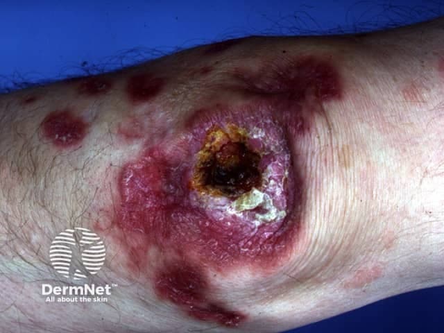 Clinical photography of a solitary cutaneous lesion on the distal leg consistent with lupus vulgaris (cutaneous tuberculosis). The image depicts a well-demarcated, annular to oval plaque with an erythematous to violaceous border and a central ulceration/crusted necrotic area. Surrounding skin shows coalescing erythema, mild edema, and postinflammatory hyperpigmentation. The surface center demonstrates crusting and a recessed, necrotic core with surrounding pale tissue, suggesting chronicity. The lesion size appears moderate and border is indurated. The anatomy is the integumentary system focusing on skin of the lower leg; the view is a single external surface close-up, taken in standard lighting without dermoscopic magnification. There is no visible active purulence. The morphological features, such as crusted ulcer with expanded border and plate-like scale, are compatible with lupus vulgaris, a form of cutaneous tuberculosis caused by Mycobacterium tuberculosis complex. The image emphasizes the chronic, slowly progressive nature and potential for secondary infection. Pathophysiology involves granulomatous inflammation with caseating necrosis; clinically, lupus vulgaris may present with apple-jelly nodules on diascopy, scarring, and deformity if untreated. The diagnostic significance lies in correlating dermatologic findings with microbiologic and histopathology confirmation, guiding antituberculous therapy and public health measures. Potential clinical use: dermatology education, TB cutaneous clinic, differential diagnosis workshops, teledermatology triage.