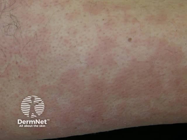 This is a clinical dermatology photograph capturing erythema marginatum on the skin of the lower limb. The modality is Clinical photography; technique: naked-eye, color-balanced image. The observed lesions are erythematous, annular plaques with central clearing and pale, sometimes hypopigmented centers. Lesions appear as rings with slightly raised margins and a uniform pink-to red hue; they range from 0.5 to 2 cm in diameter and may coalesce into larger plaques. The rash is typically non-pruritic and evanescent, with temporary eruption that may migrate or fade over hours to days; distribution commonly involves the trunk and proximal limbs, with sparing of the face. The image may reflect erythema marginatum, a cutaneous manifestation associated with acute rheumatic fever and autoimmune inflammatory processes. In longer-standing presentations, the rash signals preceding or concurrent carditis and migratory arthritis; therefore clinical correlation with recent group A Streptococcus infection, elevated ASO titers, and echocardiography is essential. Differential diagnoses include urticaria, erythema multiforme, pityriasis rosea, and drug-induced eruptions. Clinically, this finding has diagnostic significance as a major criterion in rheumatic fever per Jones criteria; management focuses on antibiotic treatment of streptococcal infection and secondary prophylaxis. This image serves educational purposes for medical students, residents, and researchers studying connective tissue disease and pediatric rheumatology.