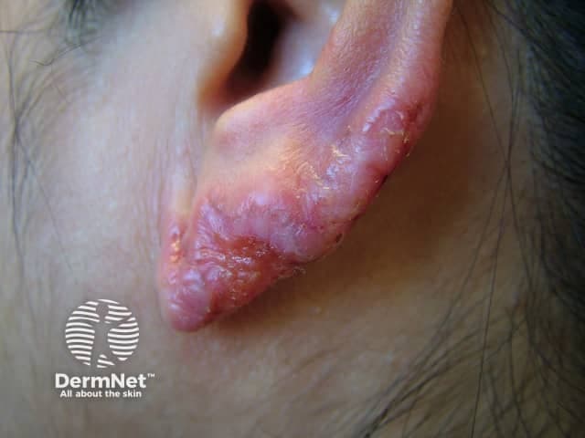 This is a high‑resolution clinical photograph of a left auricular skin lesion captured during external examination. Modality: Clinical photography; Technique: digital color image, standard exposure, lateral and frontal views of the pinna encompassing the helix and adjacent antihelix. Anatomical localization: auricle of the external ear, cutaneous layer with involvement of the skin and superficial subcutaneous tissue; no evident deep tissue penetration. Visual features: erythematous to violaceous plaque with irregular, undermined margins, surface scaling, crusting, and mild adjacent erythema; there is subtle cortical lichenification and focal atrophic change along the lesion’s edge; overall appearance suggests a chronic process with slow evolution. Clinical impression: findings are compatible with lupus vulgaris (cutaneous tuberculosis) presenting on the ear, a typically indolent plaque-type lesion that may ulcerate and scar over time. Significance: in TB‑endemic settings, lupus vulgaris should be considered in chronic auricular plaques; correlate with tuberculosis screening (Mantoux or IGRA), histopathology, culture, and PCR for Mycobacterium tuberculosis. Differential diagnoses include chronic eczema, discoid lupus erythematosus, granulomatous dermatitis, leprosy, keratoacanthoma. Potential clinical use: educational reference for dermatology, infectious disease, and medical training to recognize auricular lupus vulgaris and guide diagnostic workup and management. Clinical relevance: supports prompt antimicrobial therapy and lesion surveillance strategies.