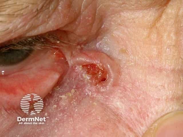 Clinical photography of an eyelid lesion consistent with basal cell carcinoma (BCC). Periocular skin of the eyelid margin shows a solitary, irregularly shaped, ulcerated papule with crusting and a translucent, pearly-like border. Telangiectatic vessels are visible within the raised lesion and surrounding erythema is present, indicating local invasion risk. The lesion is positioned at the anterior eyelid/lid margin with potential medial canthal involvement; the target tissue includes squamous-epidermal junction and periocular dermis. The image highlights classic BCC features, including indurated base, rolled borders, and a friable surface that bleeds on contact. Notably, eyelid BCC tends toward slow growth with a high cure rate when excised with adequate margins, while sparing adjacent ocular structures is essential to preserve function. Differential considerations include sebaceous carcinoma, squamous cell carcinoma, pigmented melanoma, and chalazion-like inflammatory lesions. Diagnostic significance lies in recognizing peril signs requiring biopsy for histopathology—basaloid tumor nests with peripheral palisading and stromal retraction on histology confirm diagnosis. This image is valuable for clinical education, dermatology and ophthalmology training, and referral triage, aiding early recognition, patient counseling, and surgical planning for margin-controlled excision or Mohs micrographic surgery. It also supports radiologic or histopathologic correlation when assessing periocular tumor extent. Clinical documentation and research.