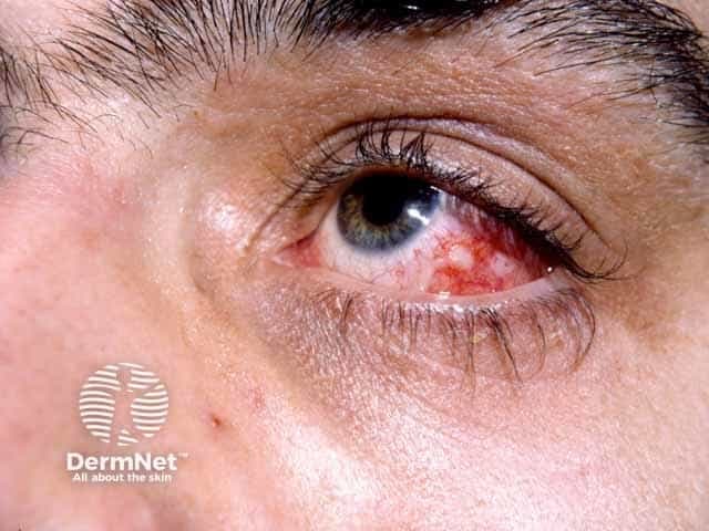 Clinical photograph (ophthalmic external/anterior segment) of the right eye showcasing anterior segment inflammation with conjunctival injection. Frontal view highlights diffuse bulbar conjunctival redness, greatest inferiorly, with adjacent vascular engorgement and mild episcleral whitening not clearly seen. The cornea shows no obvious defect in this frame, and the eyelids appear unremarkable. In the setting of Behçet disease, ocular involvement most often presents as noninfectious anterior uveitis or episcleritis, and can progress to vision impairment if undertreated. The observed redness and focal vascular congestion are findings compatible with active ocular surface inflammation and possible early keratouveitis, though histologic detail is unavailable in a photograph. This image captures a snapshot of inflammatory activity that informs clinical assessment of BD activity, helps distinguish autoimmune inflammatory processes from infectious conjunctivitis, and supports therapeutic decision-making regarding systemic immunomodulation and local therapy. Clinically, it complements other BD features such as oral/genital ulcers and skin lesions, and may prompt rheumatology consultation. In educational use, it illustrates differential diagnosis of acute ocular surface inflammation and the importance of monitoring response to treatment over time. Keywords: anterior uveitis, episcleritis, noninfectious ocular inflammation, BD activity scoring, immunosuppressants, corticosteroids, pathergy, systemic therapy; educational resource for clinicians, residents, and students. Clinical decision support material.