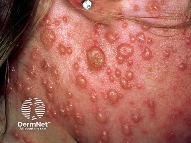 Clinical photograph of facial skin demonstrates an acute varicella-zoster infection (chickenpox) with a vesiculopapular eruption at varying stages. The image captures a close-up view of the left facial region (cheek/temporal area) showing numerous small translucent vesicles atop an erythematous, inflamed surface. Some lesions appear as dew drop vesicles; others are crusted, eroded, or coalesced into shallow plaques. The lesions are distributed in crops, with evidence of ongoing new vesicle formation alongside older crusted lesions, reflecting the characteristic centripetal pattern of varicella. The surrounding skin is mildly edematous and inflamed, with focal tenderness and pruritus typically reported in clinical practice. This presentation is diagnostic in the appropriate clinical context when accompanied by fever, malaise, and a diffuse vesiculopapular rash, though varicella can resemble herpes simplex virus infections or disseminated contact dermatitis. The image emphasizes cutaneous involvement as the primary visual clue for clinicians, educators, and researchers assessing varicella morphology, staging, and differential diagnosis. Clinically, recognition supports prompt isolation to reduce transmission and informs management decisions, including antiviral therapy considerations in adults or immunocompromised patients. This photograph serves as a visual educational resource for dermatology, pediatrics, infectious disease, and medical training exams.