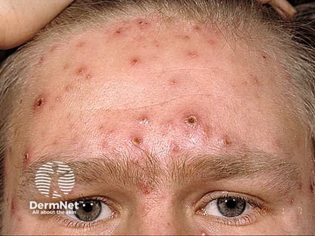 Clinical photograph of facial skin during varicella (chickenpox) infection, frontal view of the forehead. Imaging modality: Clinical photography using standard color photography under visible light; single exposure. The photograph documents vesicular lesions at multiple stages, including dew-drop vesicles on an erythematous base, small papules, and crusted plaques. The forehead demonstrates a cluster of shallow vesicles with surrounding dermal erythema and occasional crusts, while adjacent skin shows mild edema and pruritus-related rubbing. Lesions are predominantly superficial, with translucent fluid-filled vesicles and some crusted centers, consistent with secondary infection risk being low in this image. The distribution appears facial and possibly centripetal with more lesions on the face than on surrounding regions, a common pattern in pediatric varicella. No mucosal involvement is evident in this view. Differential considerations include disseminated herpes zoster in older adults or immunocompromised patients, pityriasis rosea, hand-foot-and-mouth disease, and impetiginized lesions; however, the vesicular morphology and clinical context favor varicella. Diagnostic significance: characteristic varicella rash pattern supports clinical diagnosis when combined with fever and malaise; useful for educational, triage, and telemedicine documentation. Potential clinical use cases include teaching dermatology residents, documenting eruption stage for treatment planning, and monitoring response to antiviral therapy.