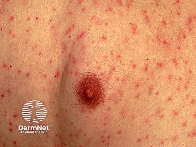 Clinical photography of skin lesions depicting a varicella (chickenpox)–like vesicular exanthem concentrated on the trunk with scattered papules and crusted lesions. The image shows numerous small erythematous papules with central vesiculation and crust formation on a backdrop of unremarkable skin. In classic varicella, lesions appear in crops, evolving from macules to vesicles (dew drops on a rose petal) and eventually crusting, often involving the trunk more than the face, and accompanied by pruritus, fever, and malaise. The depicted lesion is in a later crusted stage, while adjacent lesions are in various stages, reflecting the dynamic evolution of the eruption. Relevant imaging: not radiologic; this is dermatologic clinical photography. Diagnostic relevance: a hallmark varicella rash that aids rapid clinical diagnosis in outpatient or inpatient settings, allowing differential with disseminated herpes simplex, pityriasis rosea, or pityriasis versicolor; contagious until crusting. Clinically, management includes supportive care, antipyretics, antihistamines for itch, and antiviral therapy in high-risk patients; infection control measures to prevent transmission. Potential educational uses include dermatology training, telemedicine triage, clinical case discussions, and AI-based image retrieval for vesicular exanthems.