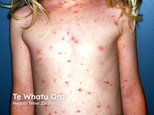 Imaging modality: Clinical photography of a pediatric patient with varicella (chickenpox) rash. Anterior frontal full-body view documenting widespread vesicular lesions on an erythematous base, most prominent on the trunk with scattered involvement of the limbs and face. The lesions appear in crops and at different stages, including macules, pruritic papules, clear-vesicles (dew drop on a rose petal), pustules, and crusted crusts. The distribution is generalized and centripetal, with higher density on the trunk and chest relative to the peripheral extremities. Skin texture shows mild erythema surrounding vesicles; some lesions show crusting as healing begins. No mucosal involvement visible in this image. Lighting is even and natural, color rendition preserved to aid lesion characterization. This dermatologic eruption is characteristic of varicella-zoster virus infection: contagious, self-limited in healthy children, typically presenting with fever, malaise, and pruritic vesicular rash that evolves over several days. Clinically, the image demonstrates classic features used for diagnosis: vesicles at multiple stages on erythematous base, cropped distribution, and trunk predominance. The image is useful for educational purposes, differential diagnosis training (including disseminated herpes simplex, pityriasis rosea-like viral exanthem), and patient counseling about contagion control and rash progression. It may guide teledermatology triage and documentation of clinical course in dermatology and pediatrics.