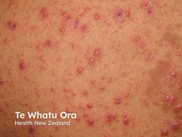 This clinical photograph shows a vesicular-papular rash on an erythematous base, distributed predominantly on the trunk with face involvement, consistent with varicella-zoster virus infection (chickenpox). The lesions appear at multiple stages, with small macules evolving to clear fluid-filled vesicles and some crusted plaques, giving the classic dew drop on a rose petal appearance. The skin is mildly erythematous around vesicles; lesions are superficial, non-palpable. No mucosal involvement is evident in this image. The distribution is generalized but has centripetal predominance. This presentation is highly suggestive of primary varicella, particularly in unvaccinated or susceptible individuals, and is contagious through vesicle fluid and respiratory secretions. Differential considerations include disseminated herpes simplex infection, disseminated herpes zoster in immunocompromised patients, or pityriasis rosea with vesicular components, though the latter is less typical. Clinically, the image supports diagnosis when accompanied by fever, malaise, pruritus, and a compatible exposure history. Reassurance, antiviral therapy consideration (e.g., acyclovir in appropriate age groups), and supportive care are relevant. The photograph is useful for medical education, telemedicine assessment, and dermatology training in recognizing staged varicella lesions, public health documentation, and patient counseling on contagion risk. This image supports clinical triage, outbreak documentation, and patient education on contagious rash in practice.