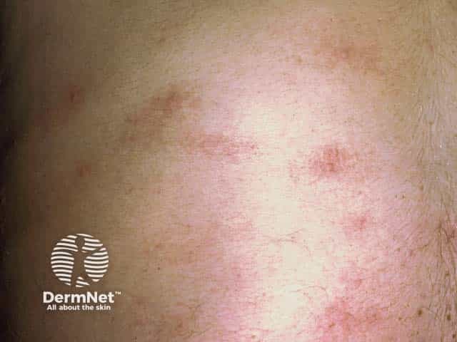 Clinical dermatology photograph of the skin displaying transient, pruritic wheals consistent with cholinergic urticaria. Modality: Dermatologic photography (clinical image); technique: high-resolution color photograph, close-up view of the cutaneous surface under standard ambient lighting; magnification not specified. Anatomical location: lower extremity skin, leg region, with clustered erythematous wheals visible on a lightly pigmented field. Visual features: well-circumscribed, raised erythematous plaques with blanching on pressure, variable size, often several millimeters to a centimeter, arranged scatteredly or in small groups; superficial dermal edema is suggested by diffuse redness and swelling, with surrounding fine border erythema. Clinical interpretation: wheals appear transient and pruritic, erupting in response to heat and exertion, a hallmark of cholinergic urticaria. Pathophysiology: mast cell degranulation and dermal edema in superficial plexuses; histology (if obtained) would show dermal edema with minimal epidermal change and mild perivascular infiltrates. Diagnostic significance: supports diagnosis when symptoms occur shortly after physical activity or temperature rise; aids differentiation from miliaria, contact dermatitis, or heat rash. Clinical relevance: helps guide management including antihistamines, trigger avoidance, and patient education; useful in educational and research settings for dermatology teaching, urticaria phenotyping, and exercise-induced hypersensitivity studies.