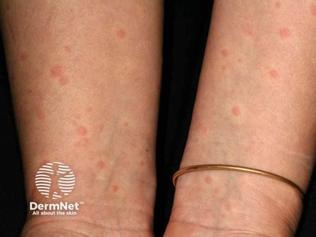 Clinical photograph of bilateral forearms showing multiple discrete 5 mm erythematous, blanchable wheals consistent with cholinergic urticaria precipitated by exercise. Lesions are superficial, well defined, round-to-oval, slightly raised, and distributed patchily across extensor surfaces of the forearms. The wheals appear shortly after exertion or warm ambient conditions and resolve within minutes to an hour, often preceding or accompanying mild pruritus. The image demonstrates a transient urticarial eruption without mucosal involvement or vesiculation. From a pathophysiologic perspective, cholinergic urticaria results from mast cell degranulation and histamine release triggered by increased core temperature and sweating; histologic findings (if biopsy were available) would show dermal edema with perivascular inflammatory infiltrate rich in eosinophils. Clinically, these findings aid differentiation from other physical urticarias such as heat urticaria, solar urticaria, or pressure urticaria, and from non-urticarial pruritic eruptions. This photograph supports diagnostic consideration in patients with exercise-induced pruritic wheals and provides material for education on recognition, documentation, and management planning. Relevance spans dermatology, allergology, pediatrics, and sports medicine; can guide antihistamine therapy, pre-exercise prophylaxis, and patient counseling on trigger avoidance and skin care during heat stress. Documentation of such patterns supports longitudinal monitoring and therapeutic response assessment.