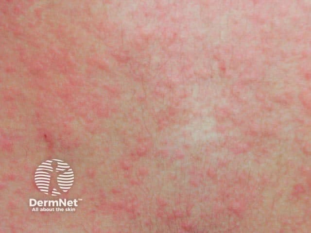 Imaging modality: Clinical photography of cutaneous surface using standard white-light illumination. Technique: frontal anterior view of the trunk with natural skin tone, without dermoscopy or special staining. Anatomical location: superficial skin of the torso with generalized distribution. Visual features: multiple small, erythematous wheals (1–5 mm) embedded in diffuse erythema; wheals are blanching under pressure and may coalesce into transient plaques; pruritus is often prominent. Pathophysiology: cholinergic urticaria is a heat- or sweat-triggered inducible urticaria resulting from mast cell degranulation. On clinical image, lesions appear as punctate or annular wheals in exposed or covered skin following heat exposure; lesions last minutes to an hour and may be accompanied by warmth, flushing, or burning sensation. Diagnostic significance: the presence of small, pruritic wheals after heat, exercise, or emotional stress supports the diagnosis; differential diagnoses include miliaria, ordinary urticaria, burns-related erythema, and dermographism. Clinical utility: this image illustrates characteristic appearance for educational reference, aids in recognition by clinicians and trainees, supports case-based teaching, and can be correlated with history and response to antihistamines. Potential use cases: medical education, dermatology exam prep, AI training for skin lesion classification, and decision support for heat-induced urticaria management.