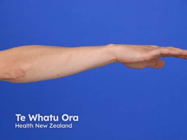 Clinical photography of a single well-circumscribed, erythematous, scaly plaque on the ventral/lateral forearm. The lesion exhibits classic annular configuration with peripheral scaling and a relatively clear central area, consistent with a ring-shaped dermatologic eruption. The observed lesion diameter is approximately 1–2 cm; the erythema is mild-to-moderate, and the scale appears fine, desquamative at the active border. This presentation is most suggestive of a superficial dermatophyte infection, i.e., tinea corporis (ringworm), though annular variants of eczema or psoriasis can mimic this pattern. The image demonstrates a well-demarcated border, thin rim of scale, and central clearing, with no overt vesiculation or ulceration. In a clinical context, one would consider mycological confirmation via potassium hydroxide (KOH) preparation and fungal culture, Wood’s lamp examination, and response to topical antifungal therapy as diagnostic adjuncts. Differential diagnoses include tinea corporis, annular psoriasis, nummular eczema, granuloma annulare, and pityriasis versicolor; however, the morphology here—scaly, active edge with central clearing—favors dermatophyte infection. This photograph is useful for dermatology education, teledermatology triage, pattern-recognition training, and patient counseling about fungal skin infections, contagiousness, and treatment expectations. Clinicians may correlate with pruritus, lesion distribution, exposure history, and lesion evolution over time.