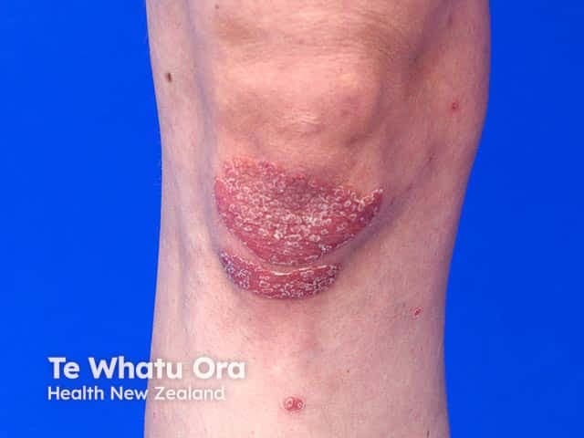 Dermnetnz