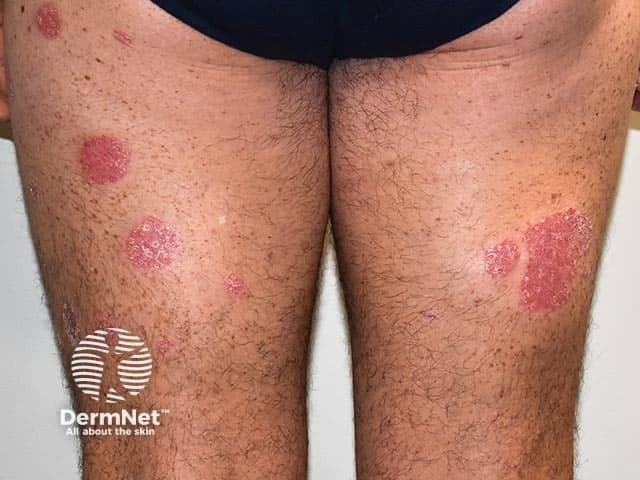Clinical photography of bilateral lower legs demonstrates features typical of plaque psoriasis. Modality: Clinical photograph; technique: Standard color digital image captured in visible light without dermoscopic magnification or contact; staining and contrast agents not used. Anatomical localization: skin of the legs, pretibial and extensor regions, bilateral (anterior aspects). Visual impression: well-circumscribed, erythematous plaques with diffuse or loosely adherent silvery scales; plaques are raised with well-defined borders and variable size, some larger patches measuring several centimeters in diameter. The distribution is symmetric and predominantly on extensor surfaces, consistent with plaque psoriasis vulgaris; surrounding skin may show mild xerosis or epidermal scaling. Pathology cannot be confirmed from a photo alone, but clinical correlation with history and examination would favor psoriasis; differential diagnoses include eczema/atopic dermatitis, tinea corporis, pityriasis rosea, and nummular dermatitis. Clinical significance: this image aids diagnosis, patient education, and monitoring of treatment response over time; it supports documentation for dermatology records and can be used in educational or research contexts to illustrate chronic plaque psoriasis phenotype. Potential clinical use cases: baseline assessment, response evaluation to topical therapies, phototherapy planning, and AI-driven lesion recognition datasets. Ethical note: ensure patient consent for image use in training datasets.