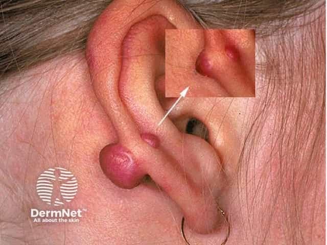 This is a clinical dermatology photograph of a left auricle (external ear) showing a solitary pink, pedunculated nodule arising from the earlobe with a smooth surface and firm consistency. A second small nodular lesion is faintly visible in the inset, near the superior helical region. The appearance is most compatible with piercing-related scar tissue such as a keloid or hypertrophic scar of the earlobe, though the differential diagnosis includes a pyogenic granuloma (lobular capillary hemangioma), epidermal inclusion cyst with surface erythema, or a benign adnexal neoplasm. The lesion demonstrates a well-circumscribed, rounded morphology with an elevated, nodular profile and a narrow stalk in some cases, suggesting an overgrowing scar rather than a fluid-filled cyst. The surrounding skin is mildly erythematous, but there is no ulceration or discharge evident in the photo. Clinically, history of piercing, trauma, and rapid growth would raise suspicion for keloid formation; a biopsy or excisional removal with histopathology would differentiate between scar tissue and vascular tumors. This image is useful for educational purposes in dermatology, medical training, and dermatoses differential diagnosis, and demonstrates typical appearance of ear-lobe nodules for teaching about wound healing disorders, scar augmentation, and management implications.