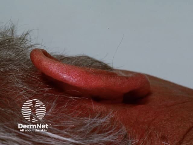 Imaging modality: Clinical photography of the left external ear (pinna) using high-resolution digital capture. Anatomical site: auricle, helix, antihelix, and surrounding periauricular skin; cutaneous tissue overlying auricular cartilage. Visual features: a broad-based, well-demarcated erythematous patch on the superior and lateral aspects of the pinna with uniform red coloration, no focal vesiculation or crusting, mild edema of the surrounding skin, and intact skin surface. Pinna appears inflamed but without purulent drainage or deep abscess signs. The background skin shows no concurrent rash elsewhere. There is no visible piercing or trauma in image. The observation suggests an inflammatory dermatosis of the ear, such as contact dermatitis or photodermatitis, rather than infection, given absence of warmth, warmth indistinct. Clinical significance: skin inflammation limited to the auricle may reflect sun exposure, allergen exposure, or irritant contact dermatitis; differential includes eczema, seborrheic dermatitis, cellulitis with fever, or less likely vasculitis. This image provides educational value for dermatology teaching, primary care evaluation of auricular dermatitis, and photo-documentation. Potential clinical use cases: triage for dermatitis vs infection, monitoring response to topical corticosteroids, sun protection counseling, documentation for derm exam. Researchers may study lesion distribution on ear skin and sun exposure effects.