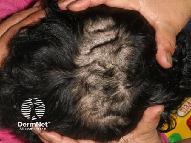 This clinical dermatology photograph captures a posterior view of the scalp illustrating patchy non-scarring alopecia with conspicuous scaling and crusting along several discrete patches in the occipital region. Hair within affected patches is sparse, with visible hair shaft breakage and reduced density. Perifollicular desquamation and mild erythema are evident at lesion margins, while surrounding scalp skin remains largely uninvolved. The distribution is focal and localized to the occipital scalp, with no obvious regrowth in the affected zones. The appearance is most consistent with tinea capitis (scalp ringworm) or another dermatophyte infection, though alopecia areata and seborrheic dermatitis are important differential considerations. Clinical significance lies in distinguishing infectious from inflammatory alopecias to direct appropriate therapy and infection control measures. The image demonstrates classic features: patchy alopecia with scale, crust, and fragile hairs; reduced pigment variation; discrete borders; and preserved epidermal integrity outside patches. Imaging modality: standard high‑resolution clinical photography, color-accurate to facilitate visual diagnosis, documentation, and educational use. Anatomical context: scalp skin over the occipital region, hair-bearing epithelium with involved follicles. Potential diagnostic workflow includes fungal microscopy (KOH prep) and culture, followed by systemic antifungal treatment (griseofulvin, terbinafine) and topical antifungals. This image supports training in pediatric dermatology and differential diagnosis of patchy scalp alopecia with scaling.