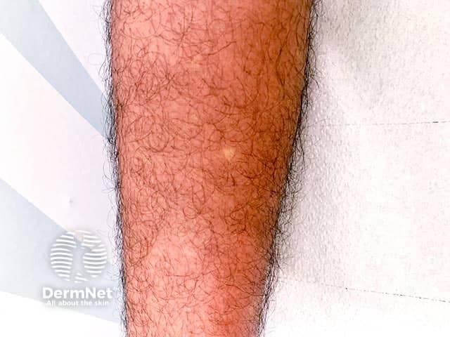 This is a high-resolution clinical photograph of the lower leg illustrating a diffuse febrile maculopapular eruption in the setting of suspected dengue fever. The image shows a broad area of coalescing erythema with patches of preserved or pale skin appearing as white islands within the red background, often described as white islands in a sea of red. The rash spans a substantial portion of the exposed leg surface and appears non-vesicular, with fine surface capillary blanching evident under light. There is no visible mucosal involvement or purpura in this view. The patient reports a 5-day history of fever, severe myalgias/body aches, and backache, compatible with the febrile phase of dengue. Morphology is consistent with a maculopapular eruption commonly seen in flavivirus infections; pattern may be confluent on extremities with interspersed hypopigmented or ischemic-looking islands. In the clinical context of dengue, such eruptions typically appear during the acute febrile period and may fade with defervescence. This image is valuable for dermatology and infectious disease education, aiding recognition of dengue-associated rash patterns, differentiation from other viral exanthems ( chikungunya, Zika ), and consideration of differential diagnoses and appropriate laboratory testing. NS1 antigen, RT-PCR, serology. It supports teaching on cutaneous manifestations of dengue.