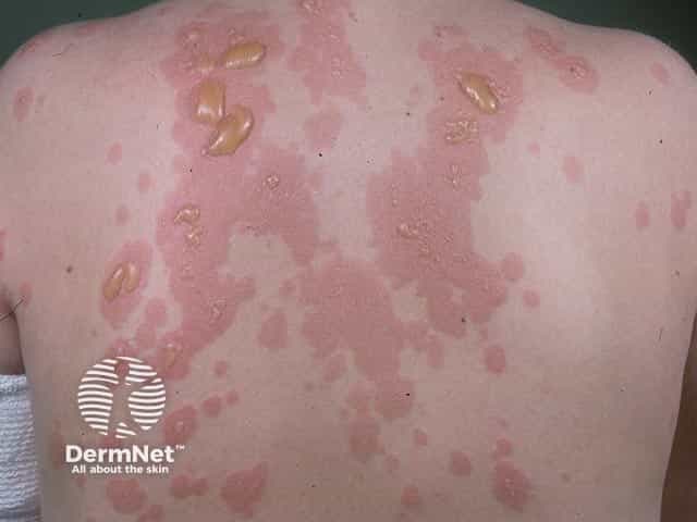 Clinical photography of the patient's back illustrating classic dermatitis herpetiformis manifestations. Modality: in vivo dermatologic imaging using standard color photography under ambient lighting; posterior trunk view highlighting a symmetric eruption. Anatomical region includes the dorsal trunk with involvement of the back's extensor surfaces. Visual features include clustered, erythematous urticarial plaques overlying tense vesicles and bullae, with gold-yellow crusts in places and superficial erosions. The lesions are discrete to coalescent, often arranged in grouped vesiculopapular configurations, with intense pruritus suggested by confluent erythema. The dermal involvement shows papillary microabscesses clinically represented by small vesicles with clear fluid; in Dermatitis Herpetiformis, histopathology reveals subepidermal vesicles with neutrophilic microabscesses in the dermal papillae; direct immunofluorescence demonstrates granular IgA deposition at the tips of dermal papillae. Clinically, dermatitis herpetiformis has a strong association with gluten-sensitive enteropathy (celiac disease) and responds to dapsone therapy and strict gluten-free diet. This image is relevant for educational assessment, differential diagnosis training (urticarial vasculitis, bullous pemphigoid, linear IgA disease), and database indexing for dermatology, medical education, and skin pathology research. Note the mirrored labeling of body surface and detailed morphology to improve search recall for dermatitis herpetiformis presentations. documentation.