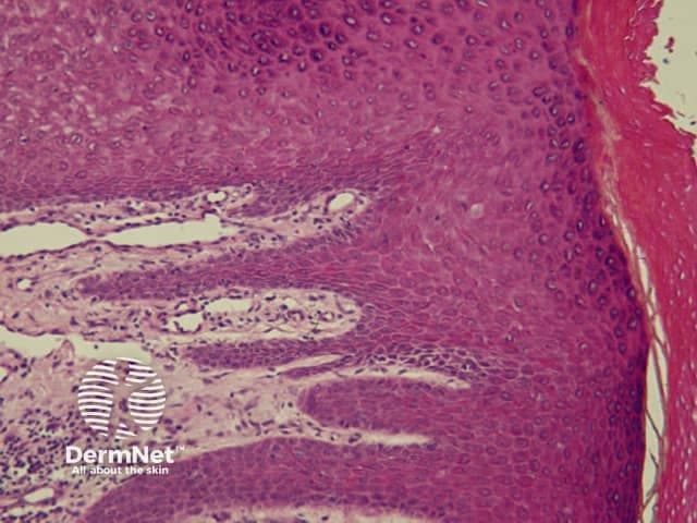 This high-resolution bright-field light microscopy image shows a hematoxylin and eosin (H&E) stained paraffin-embedded skin biopsy, mounted as a vertical histologic section. The image captures the epidermis overlying a cellular dermis with abundant connective tissue. The epidermal layers are well delineated, with a basally located layer of cuboidal to columnar keratinocytes, followed by polygonal cells of the spinous (prickle cell) layer and an eosinophilic granular layer transitioning to the anucleated keratinocytes of the stratum corneum toward the surface. Rete ridges extend into the underlying dermis, creating interlocking shelves that contribute to dermal-epidermal adhesion. The papillary dermis appears mildly vascularized with fine collagen fibrils and scattered elongated dermal papillae; the reticular dermis shows a denser fibrous matrix. No conspicuous inflammatory infiltrate, necrosis, or dysplastic cellular changes are evident within the imaged field. The specimen provides a foundational view of normal cutaneous histology ideal for educational comparison with dermatopathology specimens representing inflammatory, pigmented, infectious, or neoplastic processes. This image is useful for teaching anatomy of the epidermis and dermis, layering relationships between keratinocytes and connective tissue, and for illustrating standard histologic references in dermatology, pathology, and medical education.