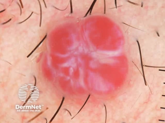 Clinical dermatology image of a solitary cutaneous pyogenic granuloma (lobular capillary hemangioma) on the skin. The lesion is a small, raised, pedunculated nodule with a bright red, vascular surface. It appears lobulated, with pale, intervening septa or lines separating conspicuous vascular lobules. The surface is smooth but friable, often bleeding with minor trauma; in this image there is no active bleeding at capture. Surrounding skin is normal and hair-bearing, indicating a non-mucosal site. The lesion is well-circumscribed, with a slightly translucent to erythematous appearance, consistent with superficial dermal capillary proliferation. Clinically, pyogenic granuloma presents as a rapidly growing, painless to tender vascular lesion that bleeds easily. The vascular lobules are arranged in a lobular architecture within a fibromucinous stroma; histology would show capillary channels lined by flattened endothelial cells. Differential diagnoses include cherry angioma, Kaposi sarcoma, amelanotic melanoma, squamous cell carcinoma, and vascular malformations; however, the rapid growth, friability, and classic lobular pattern strongly support pyogenic granuloma. Diagnostic significance lies in distinguishing benign vascular proliferation from malignancy or infection. Management may involve conservative destruction via curettage or laser, topical therapy, or surgical excision with biopsy for histopathology. Clinical correlation with trauma history is helpful. No systemic involvement is expected.